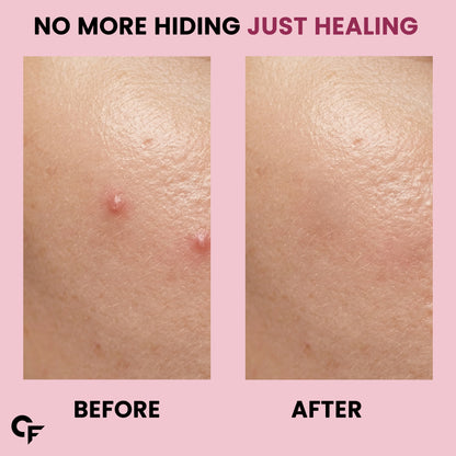 Hydrocolloid Pimple Patches with Salicylic Acid & Cica | 72 Patches