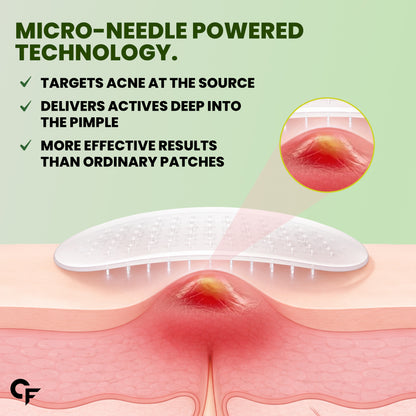 Microneedle Pimple Patches with Salicylic Acid - 9N Patches